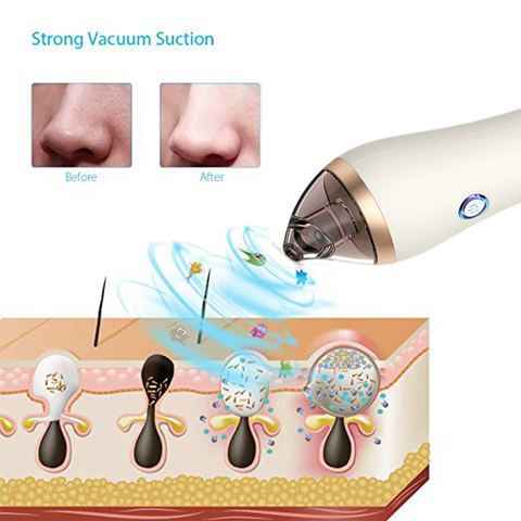 Portable Pore Cleaner – Remove Blackheads for Smooth, Healthy-Looking Skin